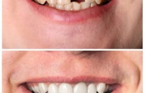 بازسازی تاج دندان