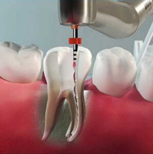 بازسازی تاج دندان