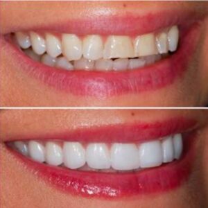 روکش زیبایی