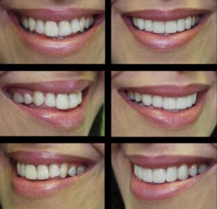 روکش زیبایی