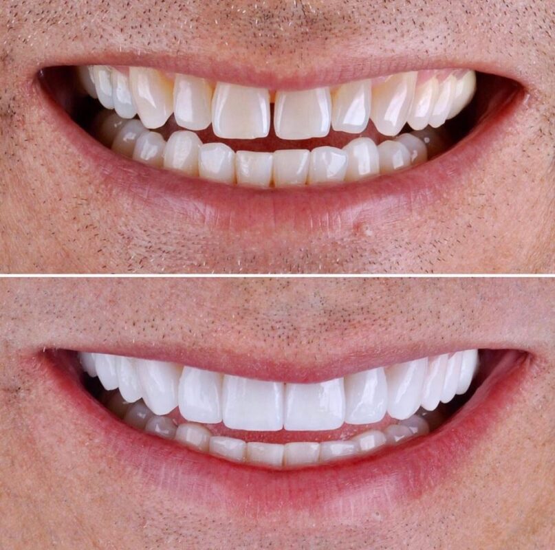 روکش زیرکونیا