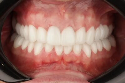 روکش زیرکونیا