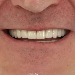 روکش زیرکونیا