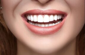 روکش زیبایی