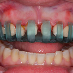 ساخت روکش دیجیتال