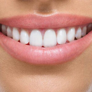 ساخت روکش دیجیتال