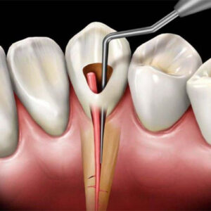 درد بعد از روت کانال
