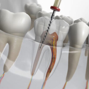 درد بعد از روت کانال