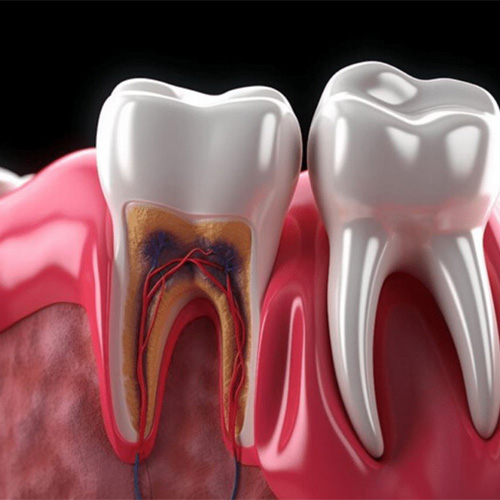 درد بعد از روت کانال