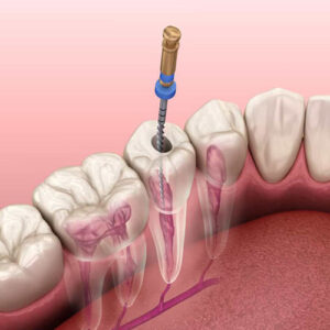 درد بعد از روت کانال