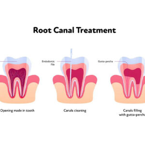 درمان روت کانال