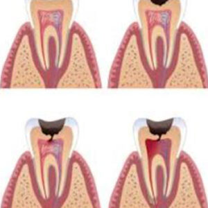 درمان روت کانال