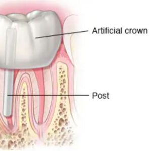 مراحل روت کانال