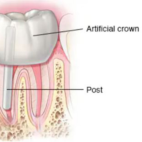 درمان روت کانال