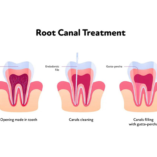 درمان روت کانال