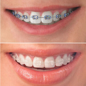 ارتودنسی نامرئی