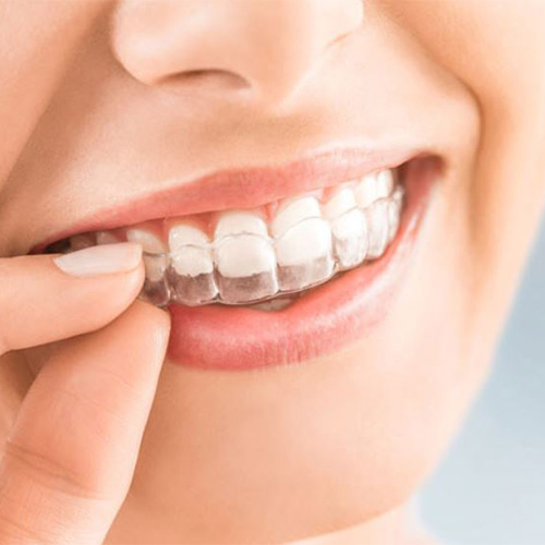 ارتودنسی نامرئی