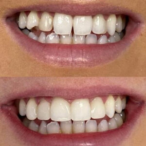 اصلاح طرح لبخند کامپوزیت