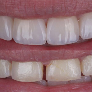 اصلاح طرح لبخند کامپوزیت