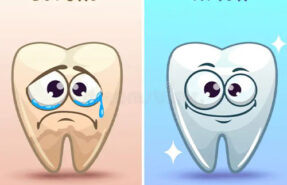 بلیچینگ و کامپوزیت