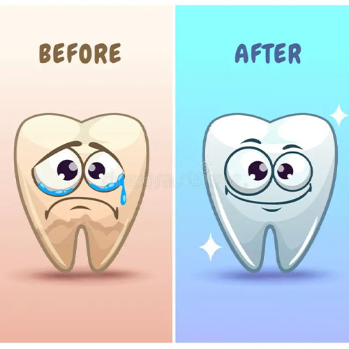 بلیچینگ و کامپوزیت