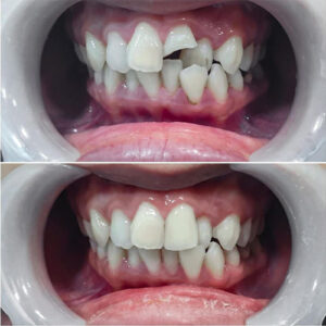 ترمیم دندان جلو