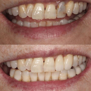 ترمیم دندان جلو