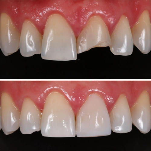 ترمیم دندان جلو