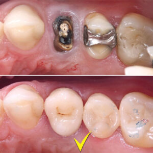 ترمیم دندان پوسیده