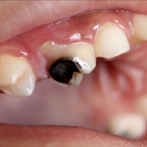 ترمیم دندان پوسیده