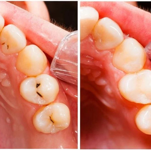 ترمیم دندان پوسیده