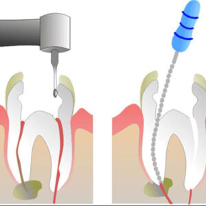 تفاوت پر کردن و عصب کشی
