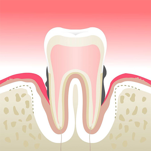 تفاوت پر کردن و عصب کشی