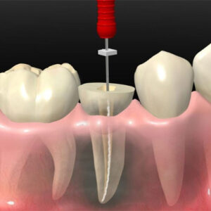 ریشه درمانی