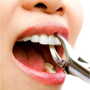 عصب کشی بدون درد