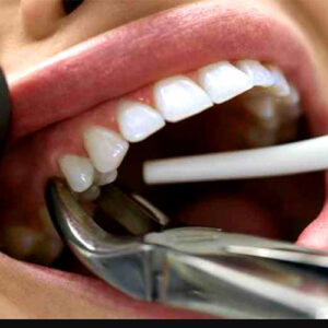 عصب کشی بدون درد