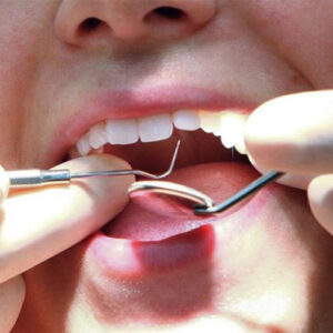 هزینه پر کردن دندان