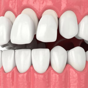 ونیر کامپوزیت