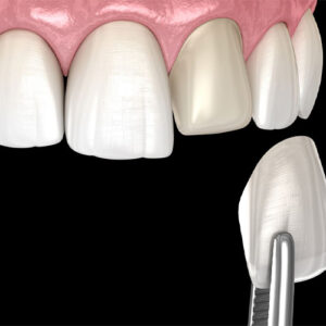 ونیر کامپوزیت