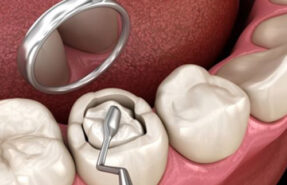 پر کردن دندان بدون درد