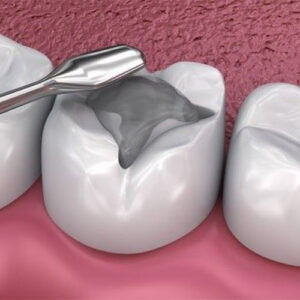 پر کردن دندان بدون درد