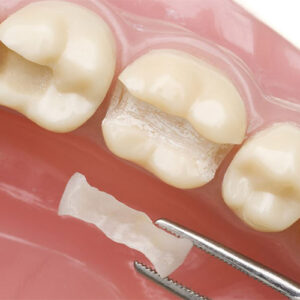 پر کردن دندان بدون درد