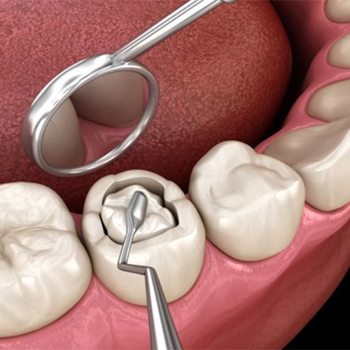 پر کردن دندان بدون درد