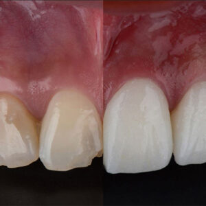 کامپوزیت ونیر