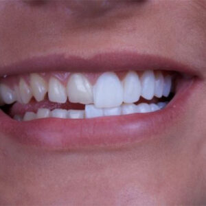 کامپوزیت ونیر