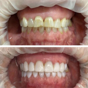 کامپوزیت ونیر