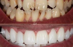 کامپوزیت ونیر