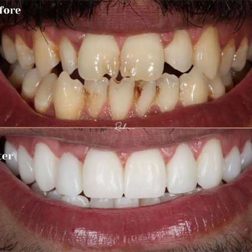 کامپوزیت ونیر